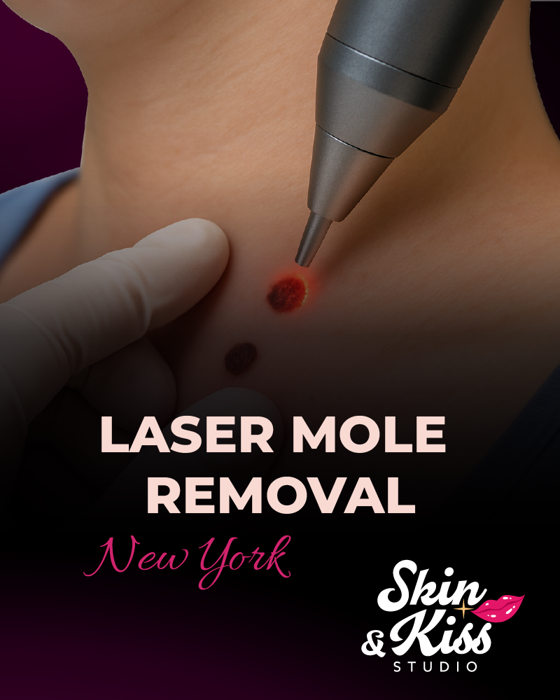 Mole removal
